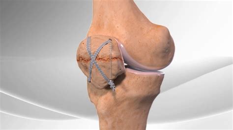 Patella Fracture - Carolina Regional Orthopedics