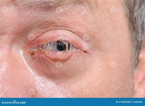 eye  bacterial purulence conjunctivitis    pink eye