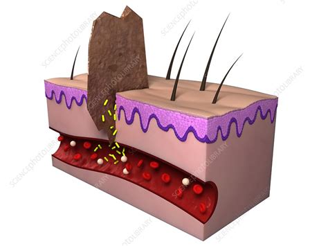 wound infection artwork stock image  science photo library