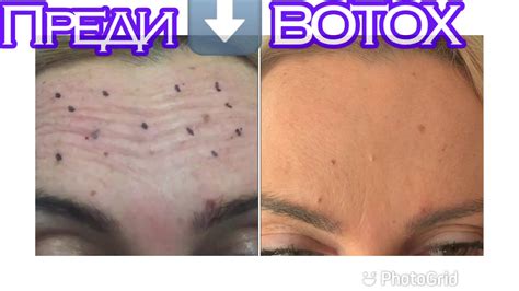 360лв. Botox-Лифтинг на лицето от 3-зони (вертикални бръчки на челото ...