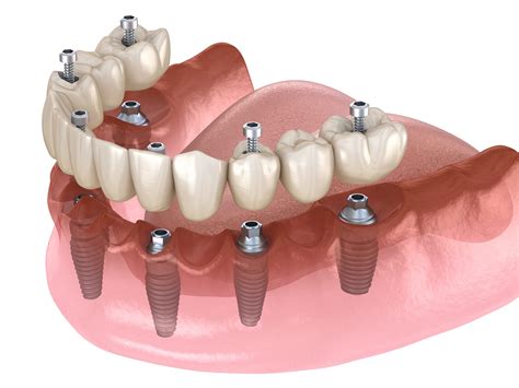 Digitally Guided Implant Surgery Birmingham - St. Paul's Square Dental