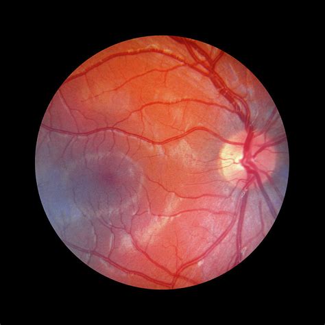 fundus camera image   normal retina  photograph  rory