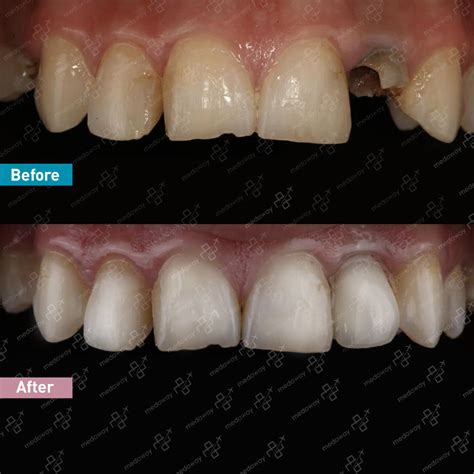 Dental Implants Turkey - Individual, Full Mouth & All on 4 | MedAway