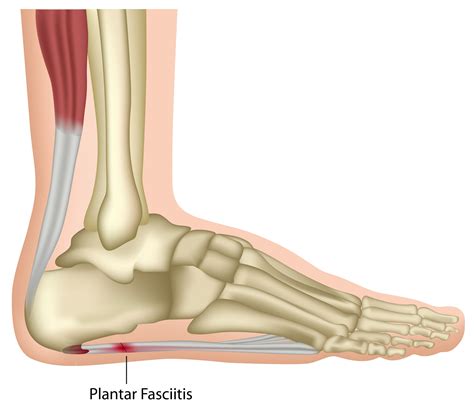 Plantar Fasciitis - Heel Pain Causing A Hobble In The Morning