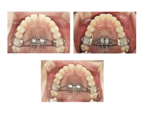 MSE vs. MARPE: Compare Orthodontic Expanders