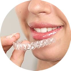 Aligner Care – Oral Creation