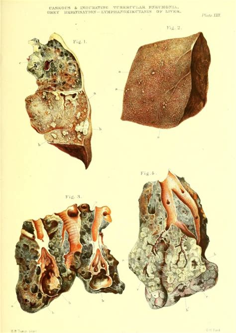Atlas patološke anatomije pluća, 1888. godina. - Fascija.com