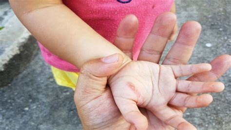 Ожоги у детей: как правильно действовать | MedAboutMe