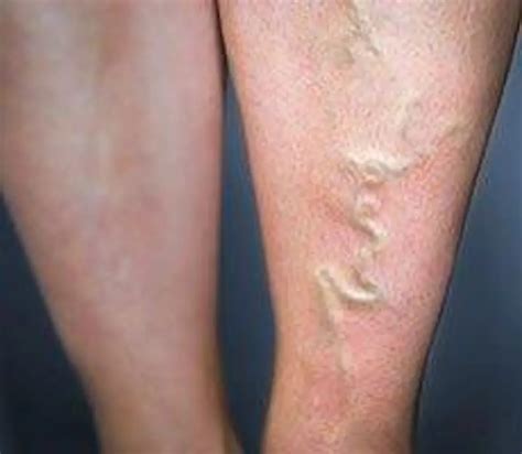 Varicose Veins for Plano and McKinney, TX | Heart and Vascular Care ...