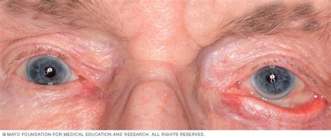 Ectropión - Síntomas y causas - Mayo Clinic