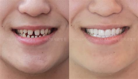 Veneers Before and After