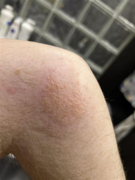 Starting with abit of itchy och burning sensation. Its recurring