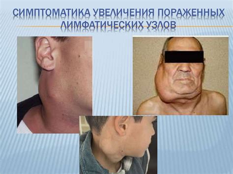 Болезнь Ходжкина (лимфогранулематоз) - презентация онлайн