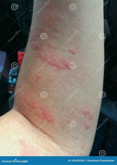 Allergic Dermatitis On The Skin Of A Woman`s Back. Skin Disease