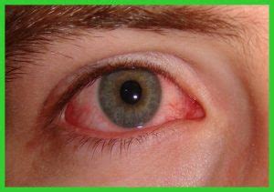 O Que É Cegueira Noturna - Cegueira noturna: o que é, causas, sintomas e como prevenir - Dicas de ...