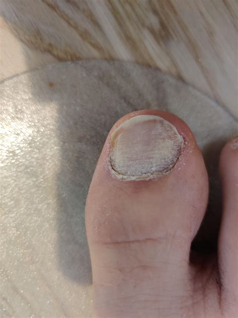 Terbinafine side effect : NailFungus