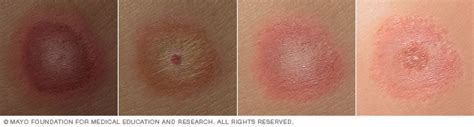 Lyme disease—Claregalway.info