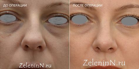 Пластика носа фото - Зеленин Н. В.