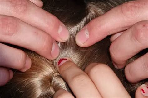 Why Do Head Lice Itch? - pestwhisperer.com