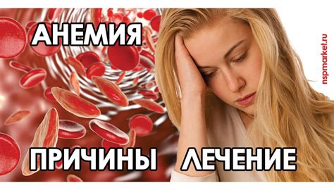 Железодефицитная анемия, анемия у детей, симптомы и лечение анемии