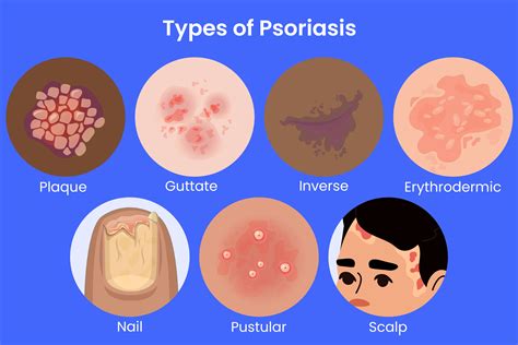 Discoid Psoriasis Pictures Types Of Psoriasis (psoriasis Pictures)