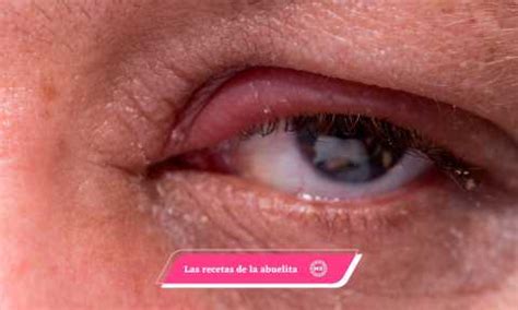 Cómo aliviar los orzuelos o “perrillas” en los ojos | Mexicanal.com