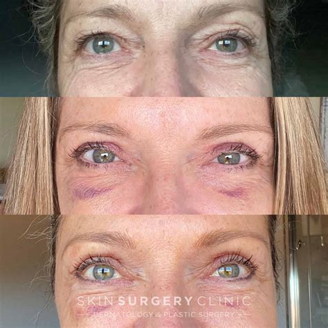 Appearance After Blepharoplasty Eyelid Lift Blepharoplasty Eyelid
