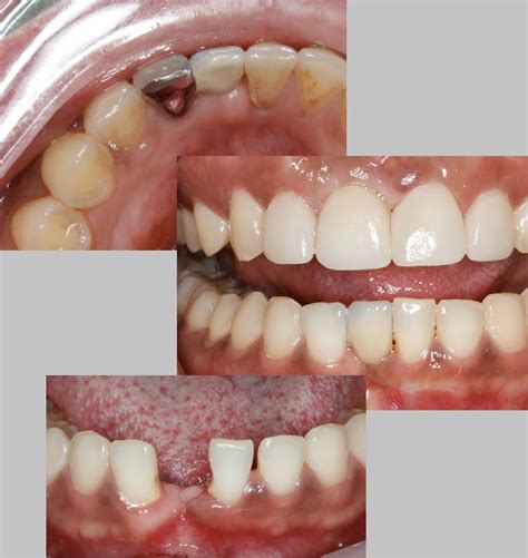 maryland bridge news dental  keys