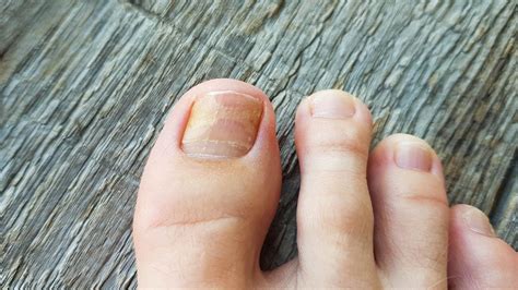 Cómo eliminar los hongos de los pies con ajo
