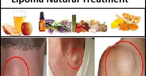 Natural Herbal Treatment: Lipoma Natural Treatment and Dietary Changes