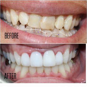 Mothlhtqqjbpqdp: Invisalign Before And After Crooked Teeth