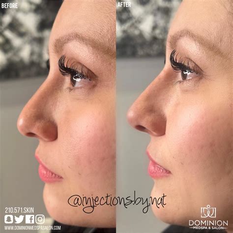 Non-Surgical Rhinoplasty in San Antonio, TX | Dominion Medspa