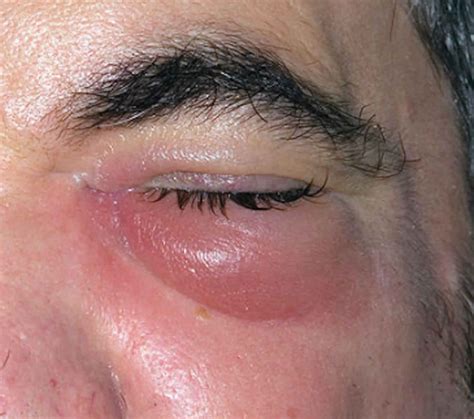 periorbital cellulitis       health