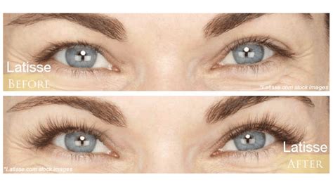 Latisse Canada | Latisse Near Me | Grow Longer Eyelashes
