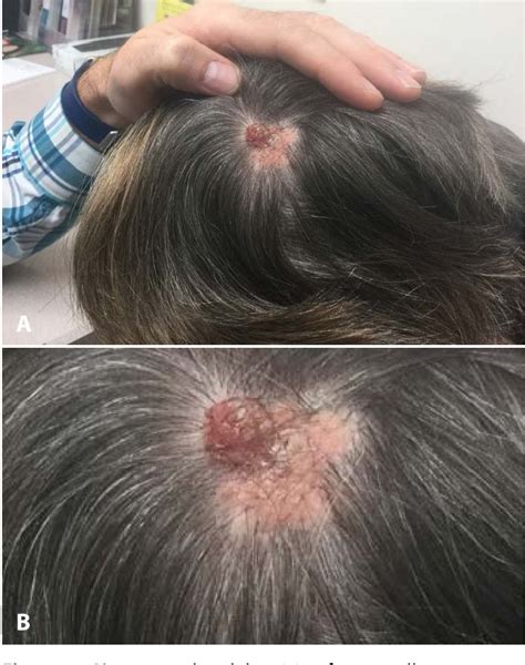 figure   syringocystadenoma papilliferum   scalp semantic