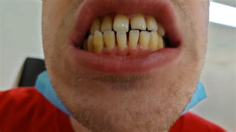 Why Are My Bottom Teeth Buzzing at Justin Conway blog