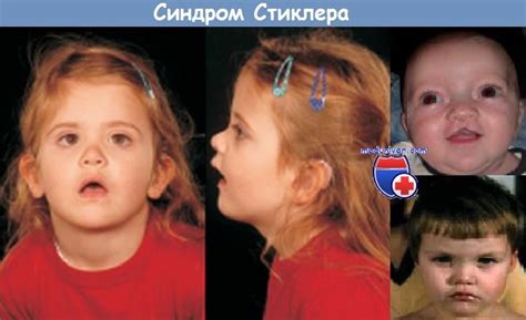 Изолированные аутосомные нейросенсорные тугоухости. Изолированная ...