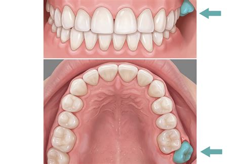 digital orthodontic workflow  treating severe scissor bite phrozen