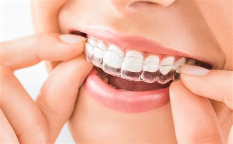 Invisible Orthodontics – Clear Aligners - GSBS Medical Trust Mumbai