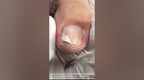 КАК ЗАЧИСТИТЬ ОНИХОЛИЗИС? КАК СРЕЗАТЬ НОГОТЬ НА НОГЕ? #алена ...