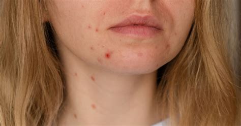 Acne Blemishes: Causes and Management - BLDG Active