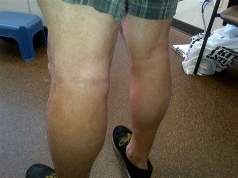 Baker's Cyst Finger Joint at Gwen Green blog