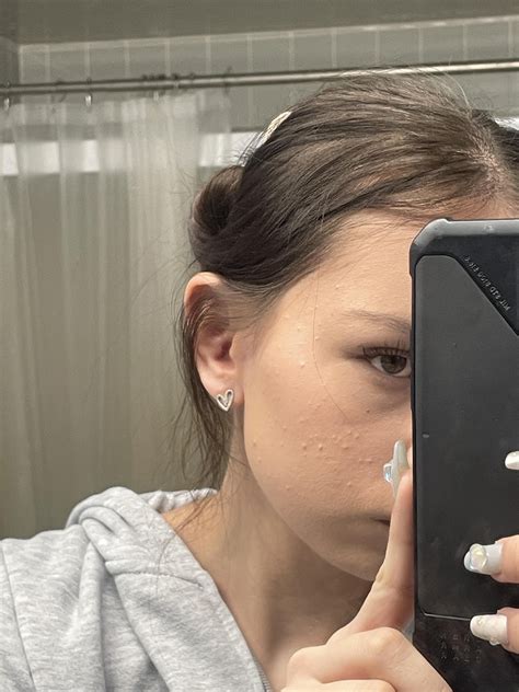 [Acne] bumps on skin help : r/SkincareAddiction