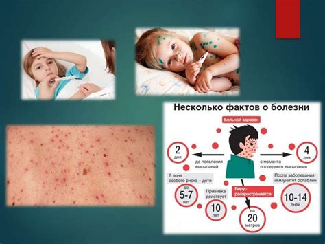 Ветряная оспа - презентация онлайн