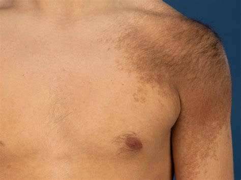Becker's Nevus Laser Treatment at Alexander Kitchen blog