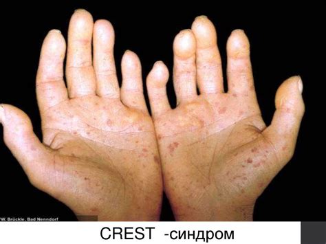Склеродермия. Жүйелі васкулиттер - презентация онлайн