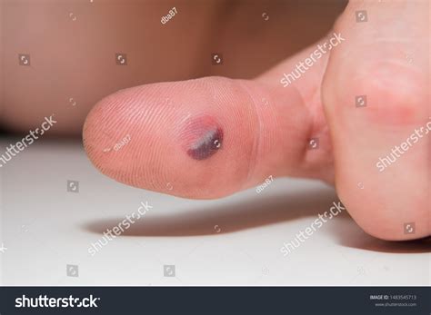 5,062 Blood blister Images, Stock Photos & Vectors | Shutterstock