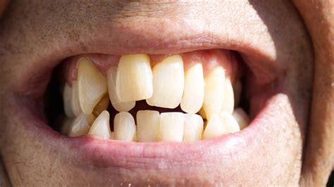 Humans used to have straighter teeth—what changed? | National Geographic