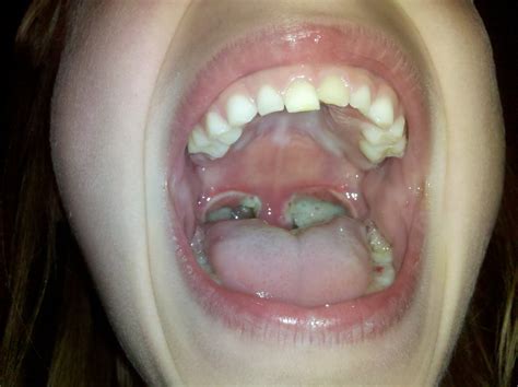 Picture Of Tonsils And Adenoids