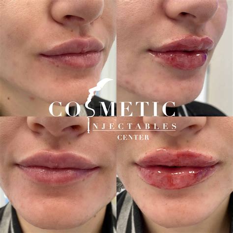 Lip Filler: Cost, Benefits, Side Effects, Reviews | Sherman Oaks